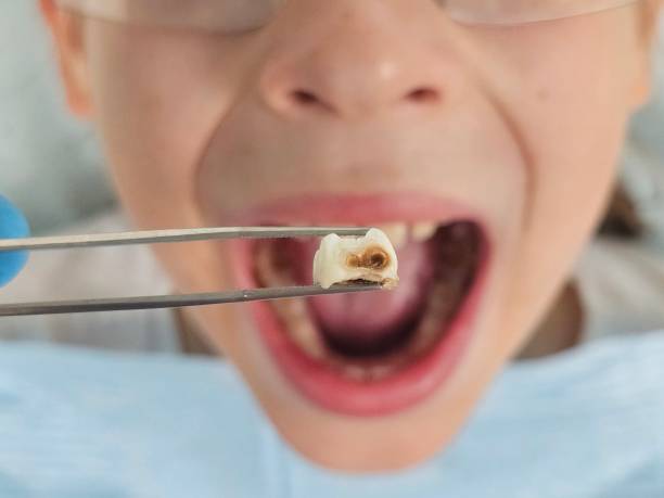 Best Chipped Tooth Repair Near Me  in West Hattiesburg, MS